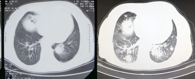 【关注】3年前确诊肺癌晚期，结果……(图4)