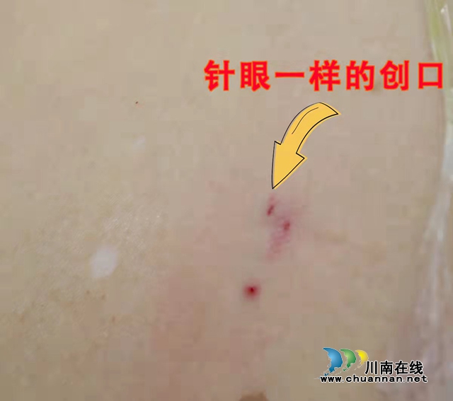 合江县中医医院手术设备再添利器，针眼开口取石不留疤痕！(图2)
