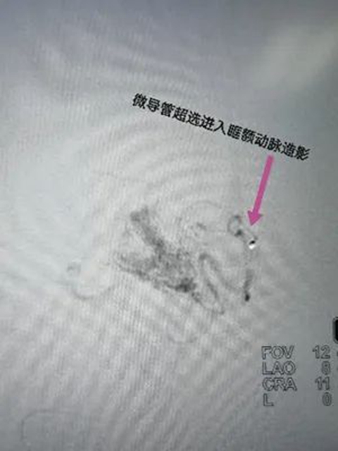 西南医大附院“拆弹专家”黄昌仁：数小时成功拆除28岁小伙脑中的“不定时炸弹”(图4)