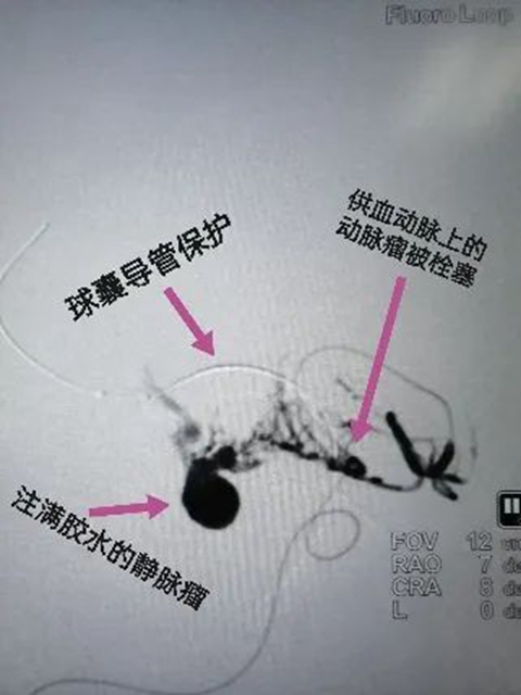 西南医大附院“拆弹专家”黄昌仁：数小时成功拆除28岁小伙脑中的“不定时炸弹”(图5)