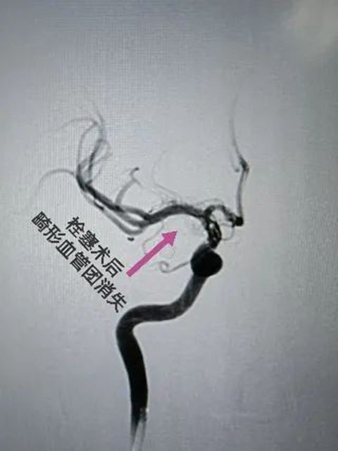 西南医大附院“拆弹专家”黄昌仁：数小时成功拆除28岁小伙脑中的“不定时炸弹”(图6)