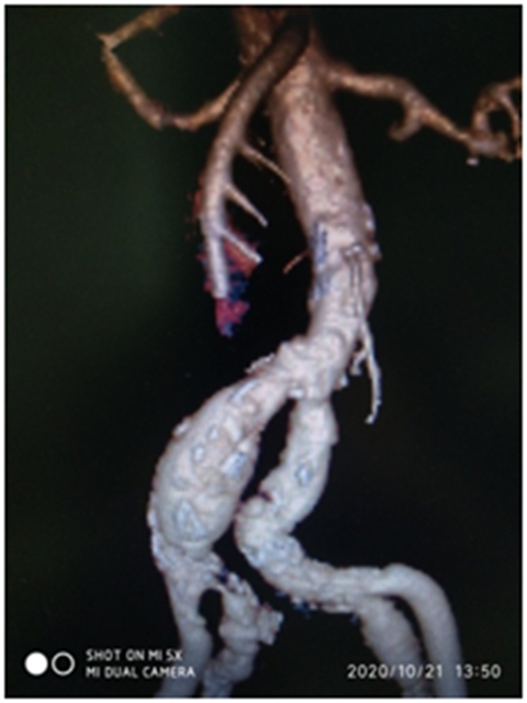 泸州市人民医院多学科团队完成首例髂股动脉血管支架手术(图1)