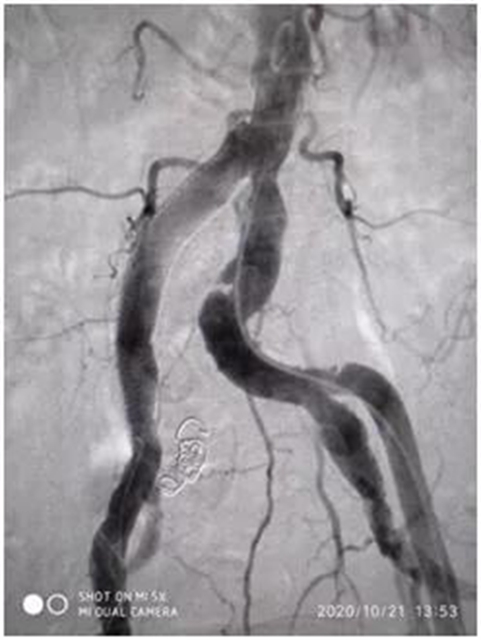 泸州市人民医院多学科团队完成首例髂股动脉血管支架手术(图4)