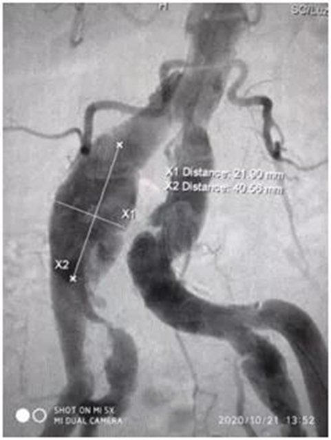 泸州市人民医院多学科团队完成首例髂股动脉血管支架手术(图5)