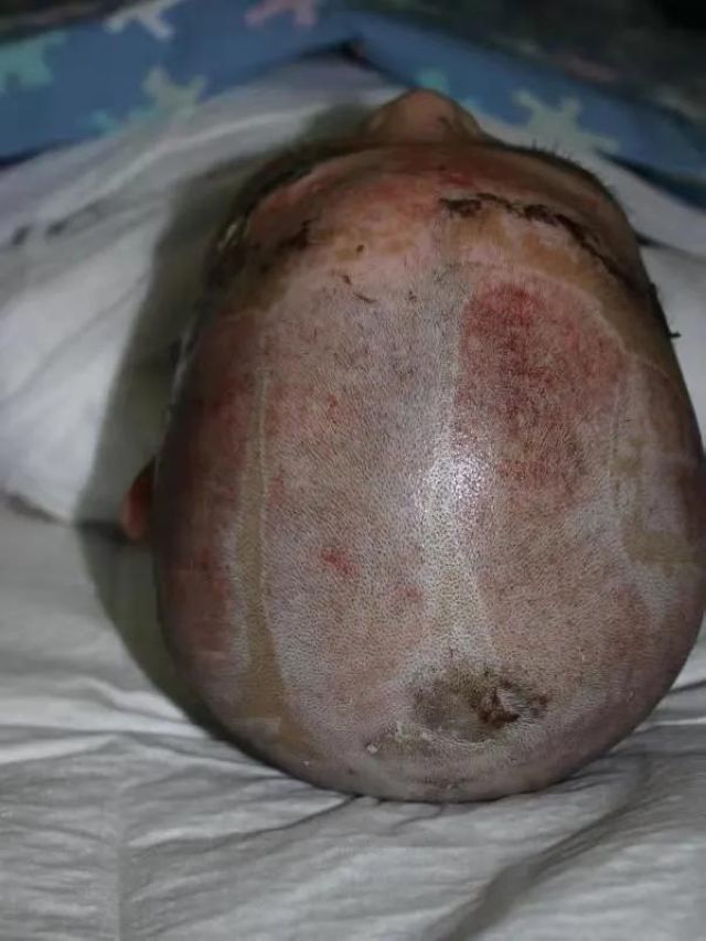 哥哥严重烧伤，7岁双胞胎弟弟捐头部皮肤不叫一声疼！(图2)