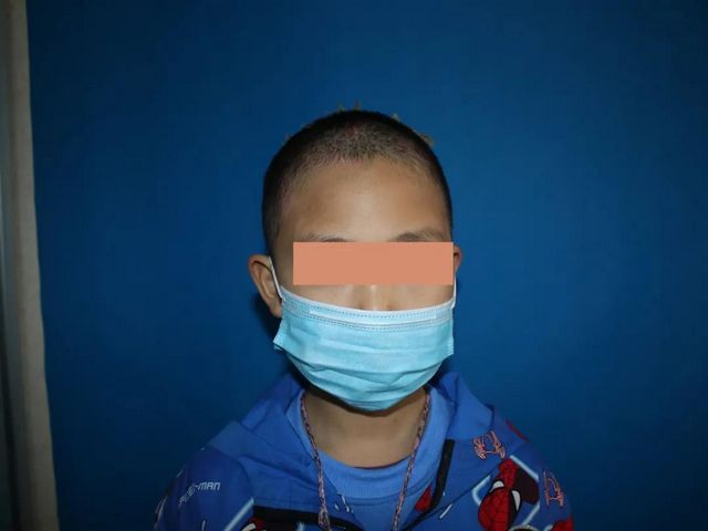 哥哥严重烧伤，7岁双胞胎弟弟捐头部皮肤不叫一声疼！(图7)