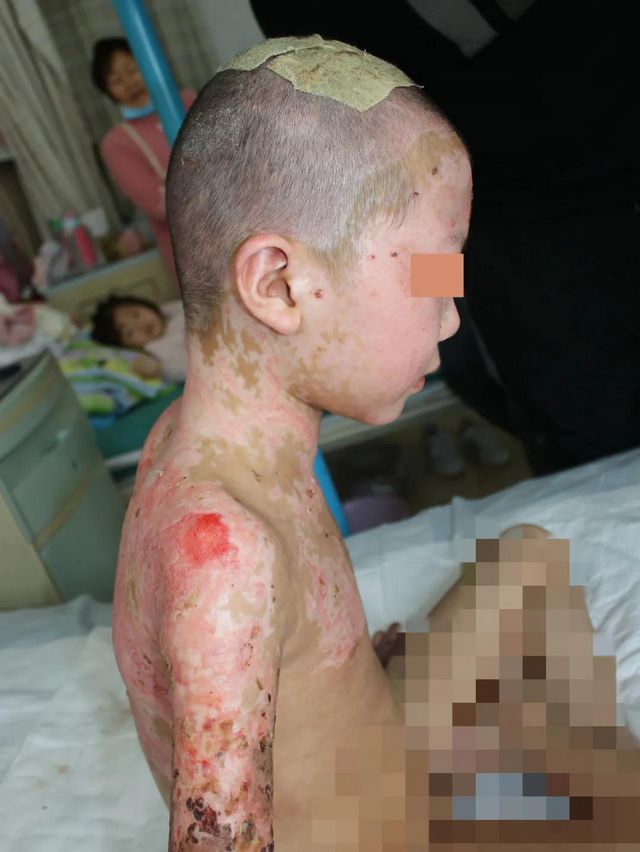 哥哥严重烧伤，7岁双胞胎弟弟捐头部皮肤不叫一声疼！(图4)