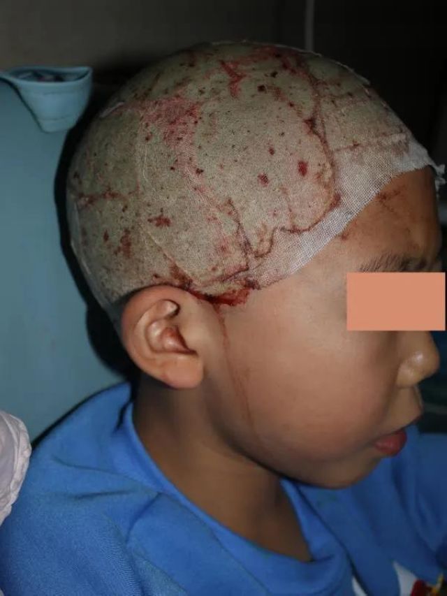 哥哥严重烧伤，7岁双胞胎弟弟捐头部皮肤不叫一声疼！(图5)
