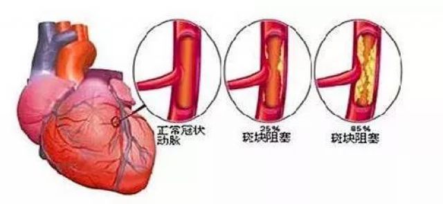你的心脏在求救！急性心梗的这些预警信号， 你知道吗？(图2)