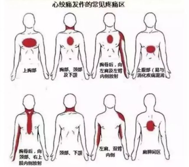 你的心脏在求救！急性心梗的这些预警信号， 你知道吗？(图8)