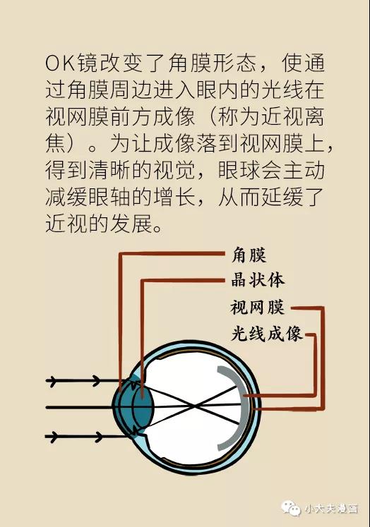 暑假到，配镜忙，OK镜真能缓解孩子近视？看专家解答(图10)