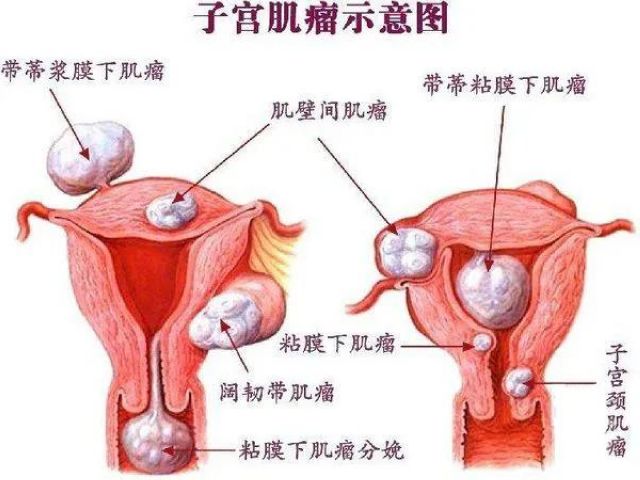 【女性】子宫肌瘤！该慌，还是不慌？(图2)