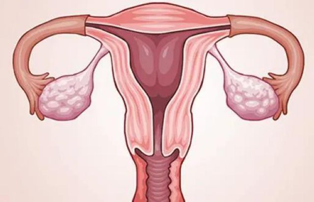 【女性】子宫肌瘤！该慌，还是不慌？(图4)