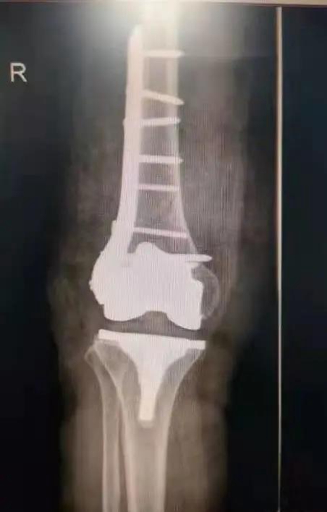 阿姨出院后亲手做鞋垫送医生：“他们每天站着做那么多手术，希望能给他们垫垫脚…”(图4)