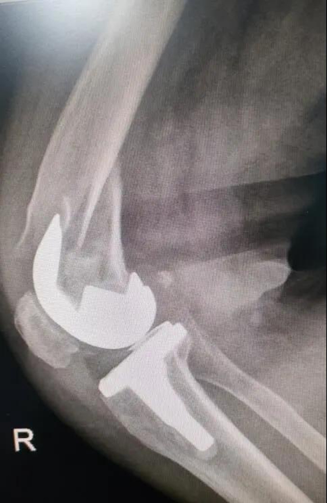 阿姨出院后亲手做鞋垫送医生：“他们每天站着做那么多手术，希望能给他们垫垫脚…”(图5)