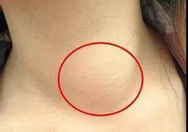 【关注】体检查出甲状腺结节,是癌吗?(图3) 【关注】体检查出甲状腺结节,是癌吗?(图3)