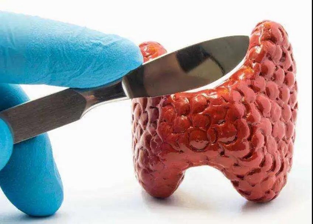 【关注】体检查出甲状腺结节,是癌吗?(图5) 【关注】体检查出甲状腺结节,是癌吗?(图5)
