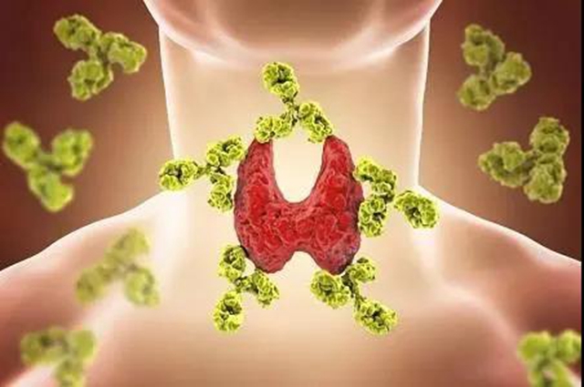 【当心】一周瘦5斤,原来是甲状腺出问题了?(图2) 【当心】一周瘦5斤,原来是甲状腺出问题了?(图2)