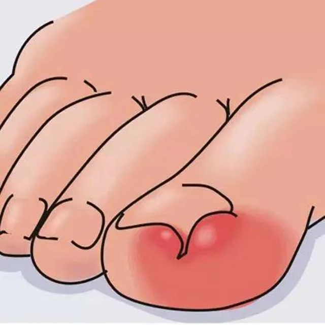 【扩散】指甲剪太短！代价可不只是痛和流血……(图2)