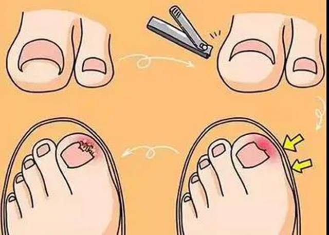 【扩散】指甲剪太短！代价可不只是痛和流血……(图4)