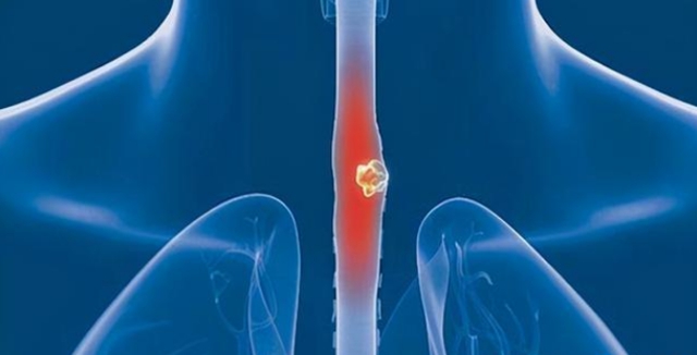 【警惕】大爷吃东西觉得哽,一查竟是癌!(图2) 【警惕】大爷吃东西觉得哽,一查竟是癌!(图2)