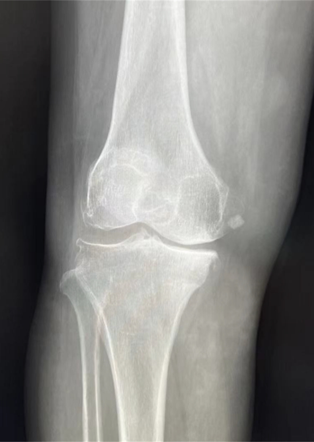 西南医大附院成功完成首例国产机器人膝关节置换辅助手术(图2)