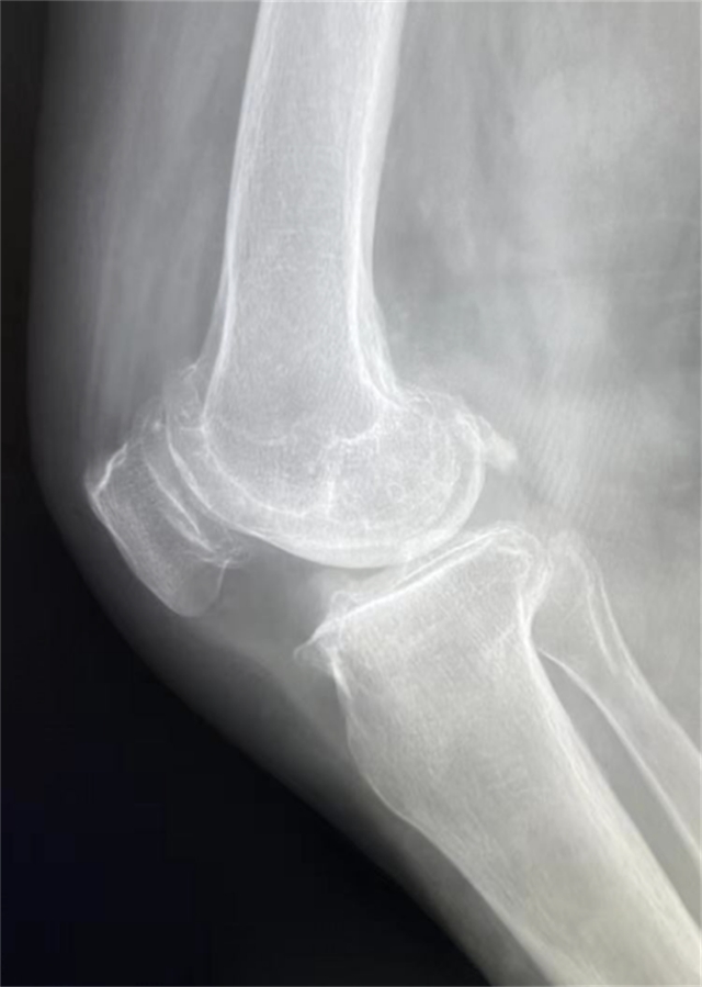 西南医大附院成功完成首例国产机器人膝关节置换辅助手术(图3)