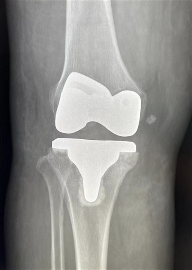西南医大附院成功完成首例国产机器人膝关节置换辅助手术(图4)