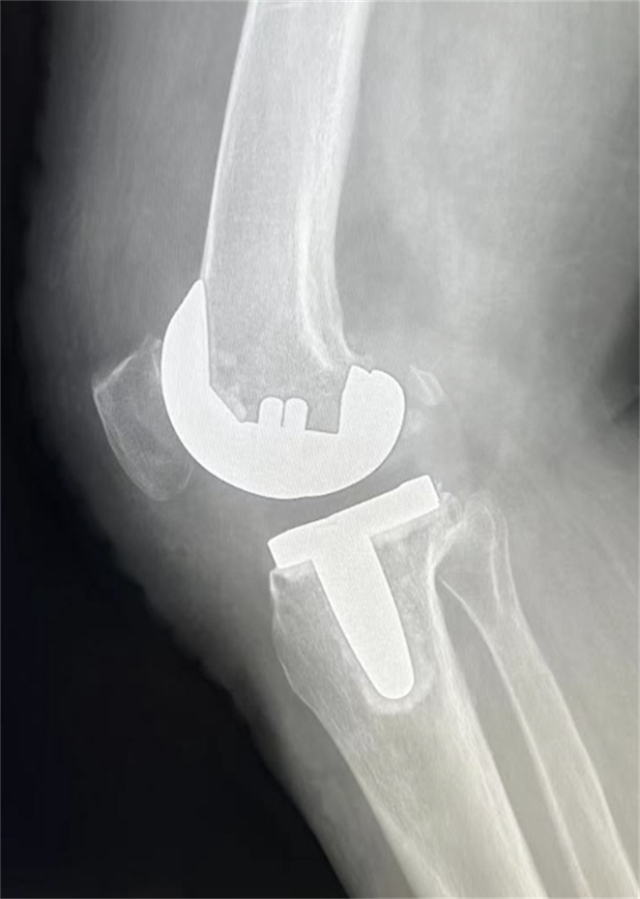 西南医大附院成功完成首例国产机器人膝关节置换辅助手术(图5)