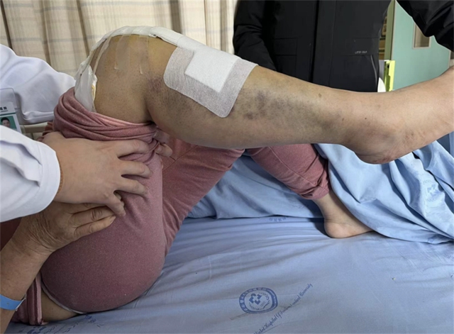 西南医大附院成功完成首例国产机器人膝关节置换辅助手术(图6)