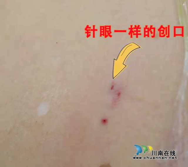 合江县中医医院手术设备再添利器，针眼开口取石不留疤痕！(图2)