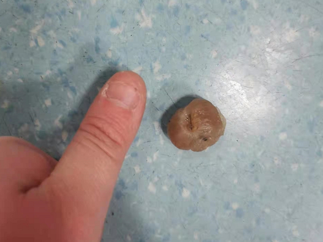 【注意】5岁女孩，桂圆卡喉，差点……(图3)