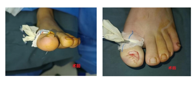 十指连心痛，泸州小伙踢球整出甲沟炎！(图4)