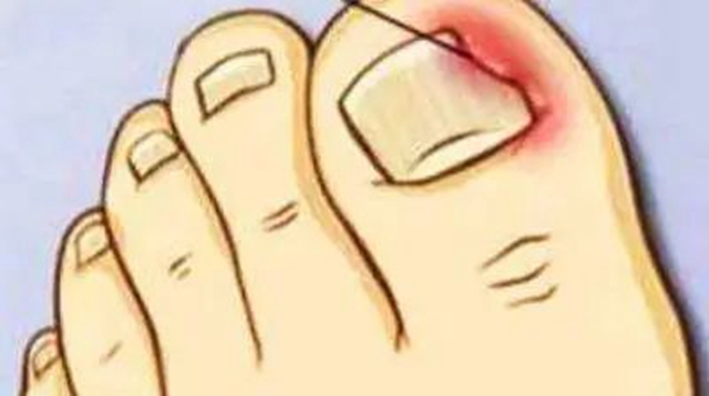 十指连心痛，泸州小伙踢球整出甲沟炎！(图5)