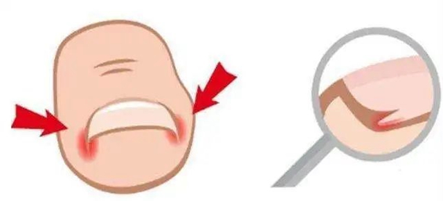 十指连心痛，泸州小伙踢球整出甲沟炎！(图6)