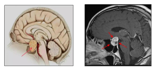 【扩散】孩子长太高?警惕脑子出问题!(图4) 【扩散】孩子长太高?警惕脑子出问题!(图4)