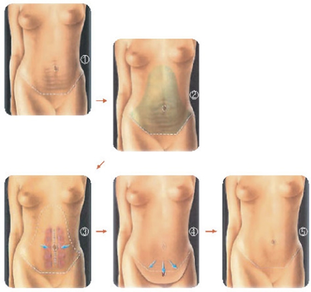 【围观】想要小腹变平坦？原来还可以这样(图3)
