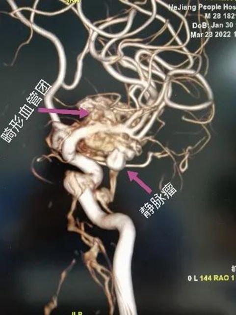 西南医大附院“拆弹专家”黄昌仁：数小时成功拆除28岁小伙脑中的“不定时炸弹”(图2)