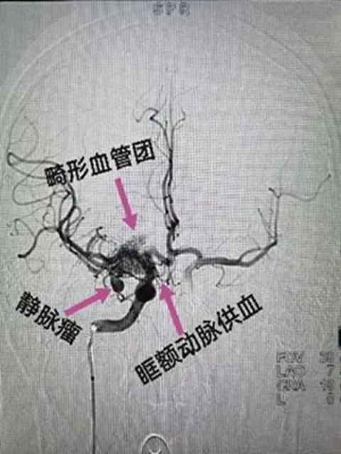西南医大附院“拆弹专家”黄昌仁：数小时成功拆除28岁小伙脑中的“不定时炸弹”(图3)
