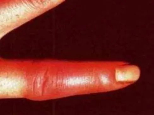 【警惕】泸州女子杀条鱼，竟感染了人畜共患病……