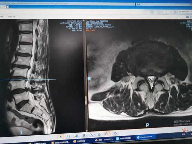 “双椎”同患病，巧手予治疗——看泸州市中医医院骨科大夫的手艺
