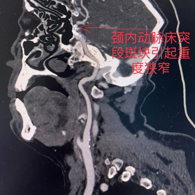 83岁大爷突发脑梗，市人医团队紧急施救挽回生命