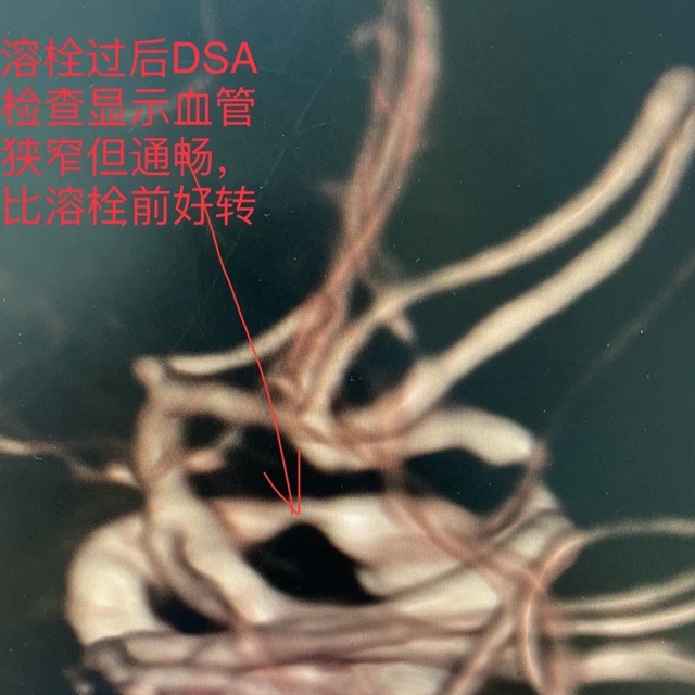 83岁大爷突发脑梗,市人医团队紧急施救挽回生命(图2) 2.jpg