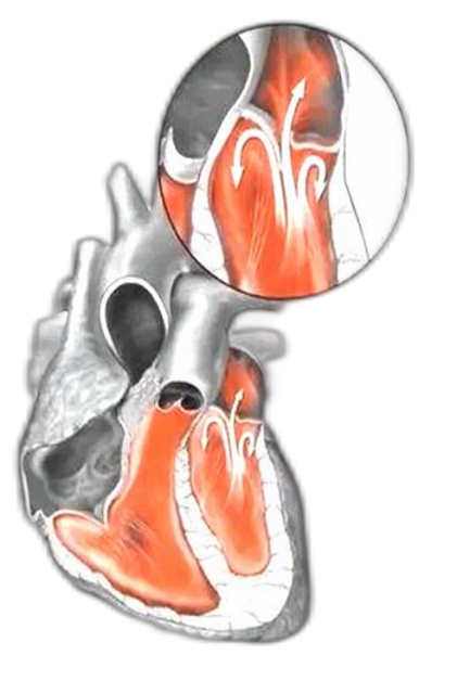 内外联合!西南医大附院心脏团队完成首2例经心尖导管缘对缘二尖瓣夹合手术(图4) 4.jpg