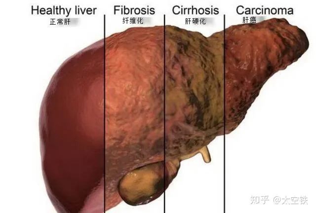 您的肝还好吗?教您一分钟看懂您的“肝弹性检查报告”(图2) 2.jpg