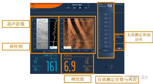 您的肝还好吗?教您一分钟看懂您的“肝弹性检查报告”(图6) 6.jpg