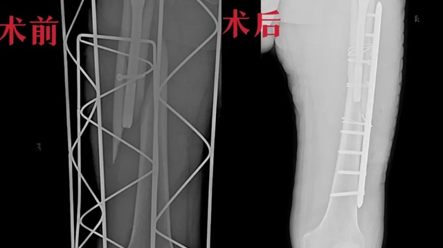 90岁老人不幸断骨两次,福欣骨科助其重获新生!(图3) 3.jpg