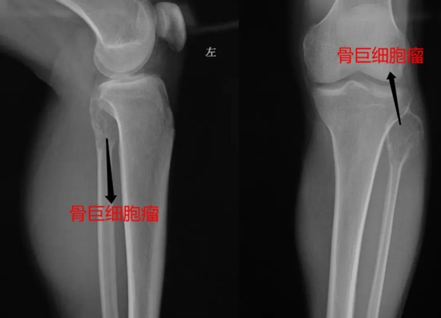 【罕见】泸州36岁男子小腿变粗长包，结果竟是……
