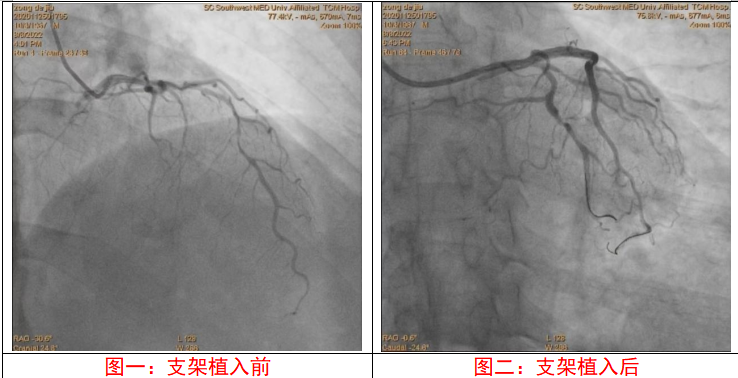 【关注】首例开展,西南医大中医院再创新高!(图4) 11.png