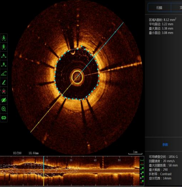 【关注】首例开展,西南医大中医院再创新高!(图7) 11.png